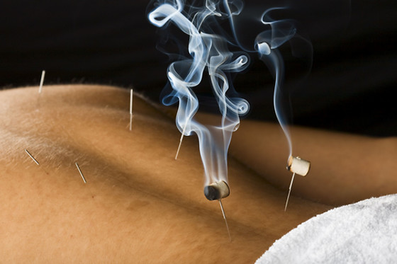 A 60-minute Full Relaxing Acupuncture & Acupressure / Therapeutic Massage with Consultation at Enjoy Acupuncture Wellness